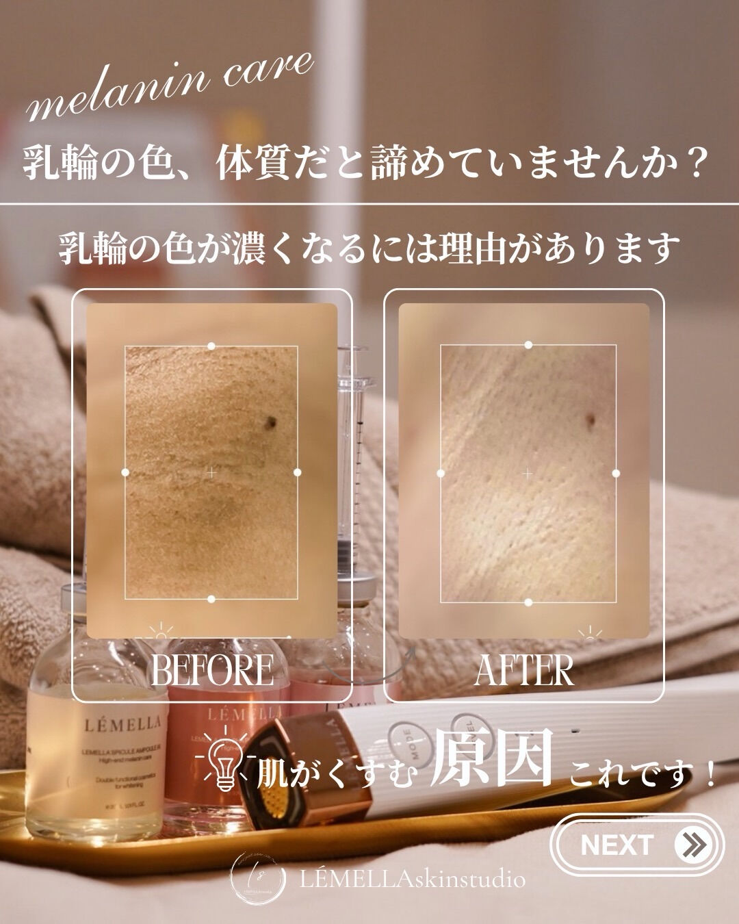 乳輪やデリケートゾーンの色、体質や年齢だと諦めていませんか？